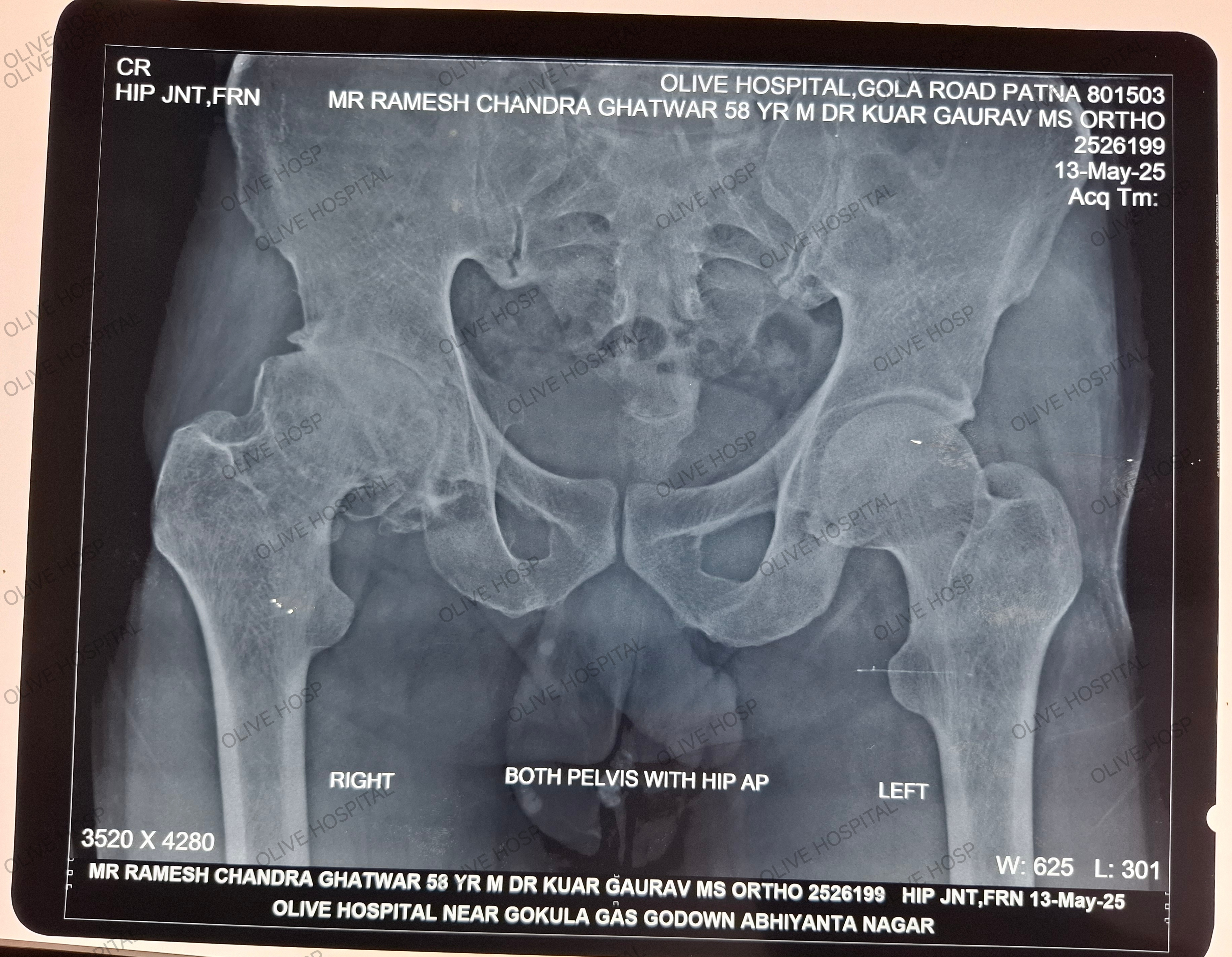 Ligament Surgeon in Patna- Olive Hospital - Dr Kumar Gaurav